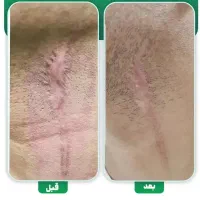 لیزر و رفع رد بخیه و اسکار