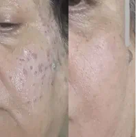 خدمات زیبایی ،فیشال تخصصی ، خالبرداری تخصصی