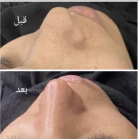فشیال تخصصی،پاکسازی پوست با دستگاه فقط ۳۰۰