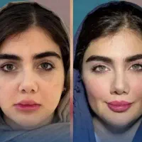جشنواره تخفیف بوتاکس فیلر مزو خالبرداری