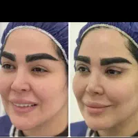 افتادگی پلک