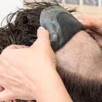 مرکز پروتز مو و کاشت مو