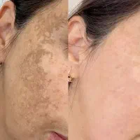 دیگه با جوش و لک هات خدافظی کن