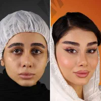 آف ۵۰٪ پکیج ابرو FOX EYE پزشک پوست مو بینی زیبایی