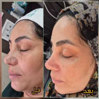فیشال تخصصی پوست + ۷۰۰ هزار تومان هدیه ویژه دیوار
