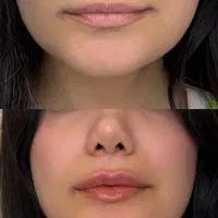 فیلر بوتاکس تمام خدمات زیبایی در کلینیک نویا