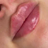 خدمات ژل لب. و ژل گونه و بوتاکس زیر قیمت