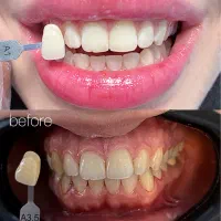 بلیچینگ دندان حرفه ای - آفر ویژه 4.3.0.0دوفک