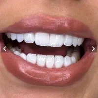 کامپوزیت دندان /تخفیف ویژه