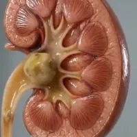 بهبود سنگ کلیه بدون جراحی و عمل