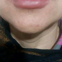 اموزش خدمات ژل وبوتاکس وانزیم حتی درمنزل