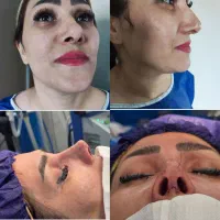 جراحی بینی  در تهران با پزشک متخصص گوش حلق بینی