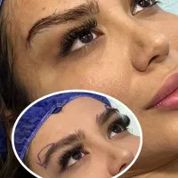 بلفارو دایرکت و لیفت ابرو متد لیزری قیمت استثنایی