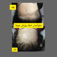 درمان ریزش مو