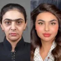 ژل بوتاکس فیلرساکشن پیکرتراشی پی ارپی مزوچربی لاغر
