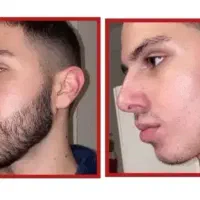 ریش سیبیل  آلوپسی  ریزش سکه ای