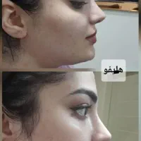 کلینیک لیفت جوانسازی هایفو سنندج (فیلرطبیعی)