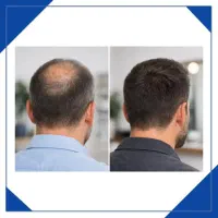 افزایش تراکم موی سر