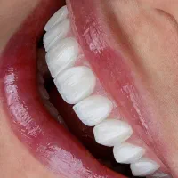 لمینت سرامیکی E.max - اقساط ۸ ماهه اصفهان