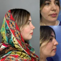 جراحی بینی با روش پیزوسرجری ،جشنواره بهاره