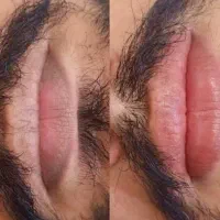 رفع تیرگی لب آقایون در کلینیک