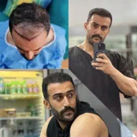 کاشت تخصصی موشیراز در رشت اقساطی بدون جراحی