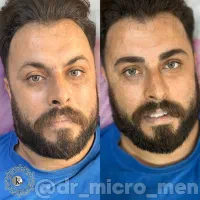 میکروبلیدینگ ابرو استایل آقایان و رفع تیرگی لب