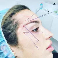 لیفت نخ از998صورت ابرو غبغب با نخ جدید کاگ اسکرو