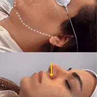 هایفوتراپی/ریموو تتو/پیلینگ