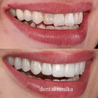 دندانپزشکی لمینیت و کامپوزیت از واحد ۹۵۰