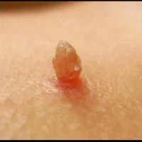 رفع hpv