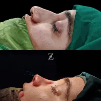 عمل بینی بدون پیش پرداخت بااقساط ماهیانه۶/۹۰۰