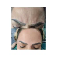 بوتاکس زیر بغل ویژه آقایان