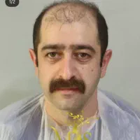 کاشت مو 20میلیون بصورت شرایطی