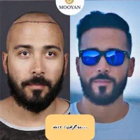 کاشت مو فقط با ۲۱ و ابرو ۱۴ تومان