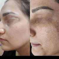 خدمات حرفه ای بهترین و تخصصی ترین مرکزلک کک مکا