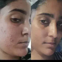 لاغری  تنبلی تخمدان کبد چرب جوش ریزش مو