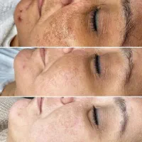 کربن تراپی صورت با دستگاه لیزر ناب وی(دکتر قاسمی)