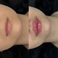 تزریق فیلر لب روسی