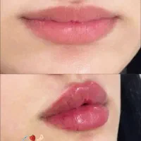 ژل ، بوتاکس ، مزو