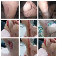 متخصص زخم و وکیوم تراپی زخم