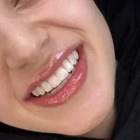 لمینیت/کامپوزیت/ایمپلنت بااقساط ویژه