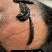 حجامت و زالو درمانی