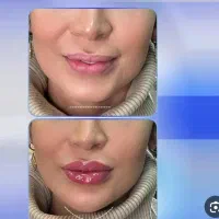 قسطی زیبا شو. ژل.بوتاکس ..