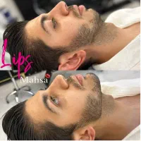 تزریق فیلر لب،ژل لب، بوتاکس،زاویه سازی،لب روسی