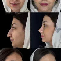 عمل بینی با هزینه ی پارسال(فقط تاپایان اردیبهشت)