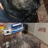 درمان ریزش مو/جوانسازی/نیدلینگ با پی آر پی/prp