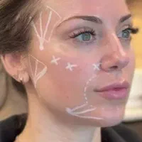 تزریق چربی صورت