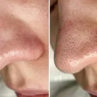 جشنواره کراتین و پروتئین تراپی مو