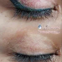 ریموو تضمینی تتو صورت